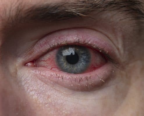 The Eye Team Got Pink Eye? Know the Facts and Get Better Faster.